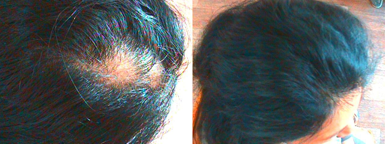 Могут ли выпадать волосы из-за проблем с кишечником у ребенка